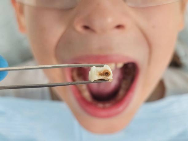 Best Broken or Cracked Tooth Emergency Dentist in Spirit Lake, ID